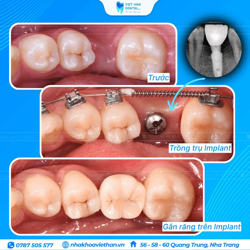 Niềng răng tảo khoảng tiền phục hình răng Implant