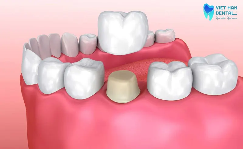 Mão răng sứ được thiết kế với hình dáng, kích thước và màu sắc tương tự răng thật