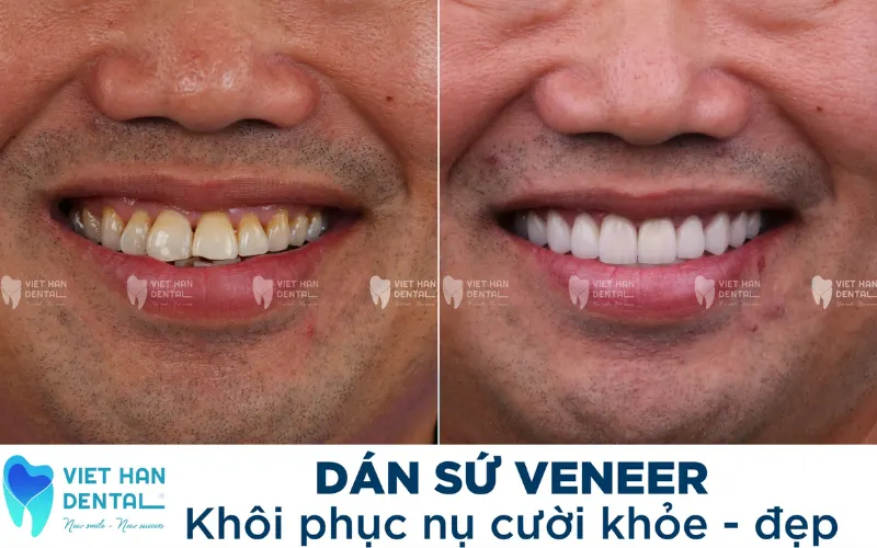 Sứ Emax