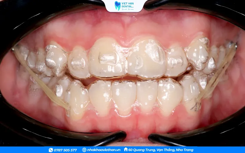 Khay niềng răng tỏng suốt Invisalign