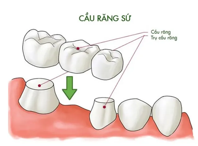 Cau Rang Su Co Tot Khong 2