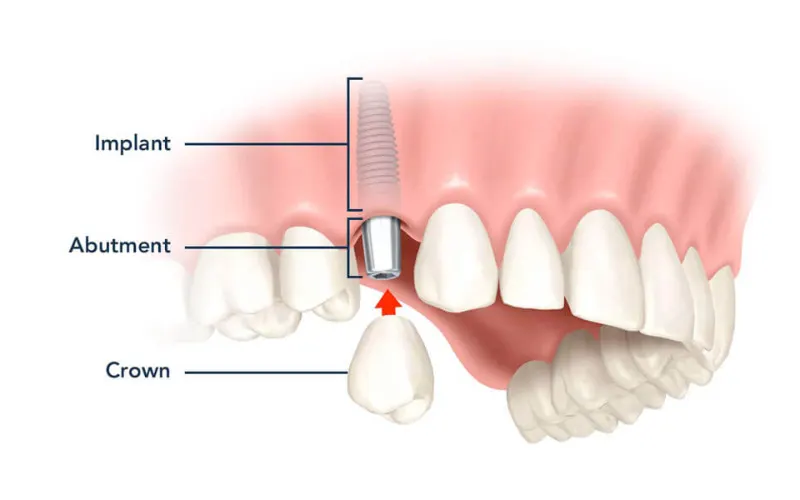 Outstanding advantages of dental implants