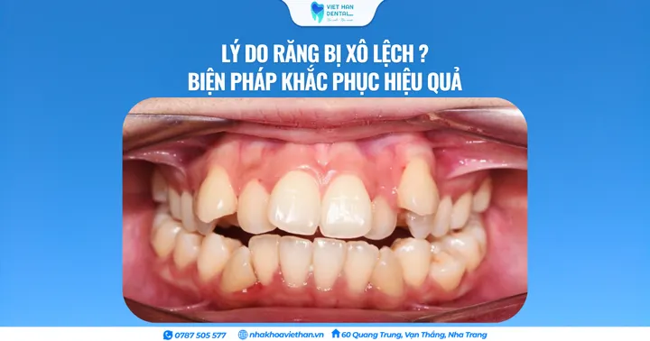 Lý do răng bị xô lệch? Biện pháp khắc phục hiệu quả