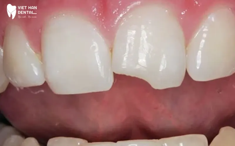 Trám răng bị mẻ