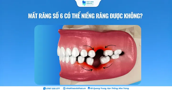 Mất răng số 6 có thể niềng răng được không?