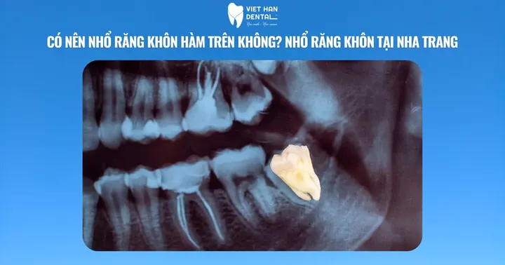 Có nên nhổ răng khôn hàm trên không? Nhổ răng khôn tại Nha Trang