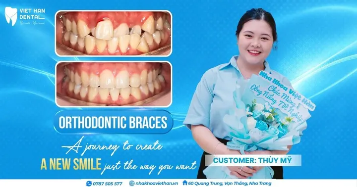 Thanks to Braces, a College Student “Transformed” Her Smile and Confidently Enjoyed an Amazing 4 Years at University