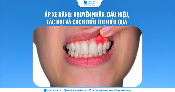 Áp xe răng: Nguyên nhân, dấu hiệu, tác hại và cách điều trị hiệu quả