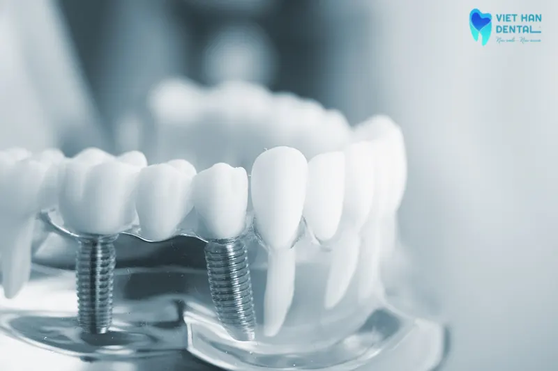 trong-rang-implant-co-dat-khong