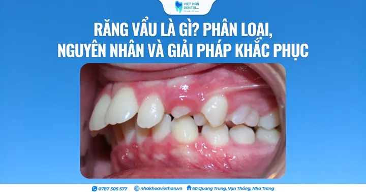 Răng vẩu là gì? Phân loại, nguyên nhân và giải pháp khắc phục