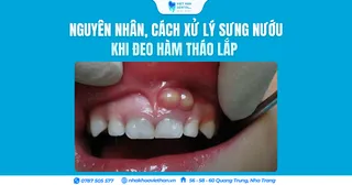 Брекеты или элайнеры: что выбрать