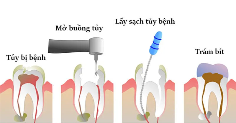 Quy trình điều trị tủy
