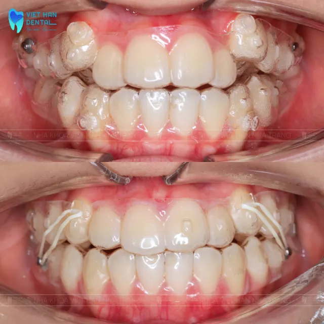 Niềng răng trong suốt&nbsp;Invisalign