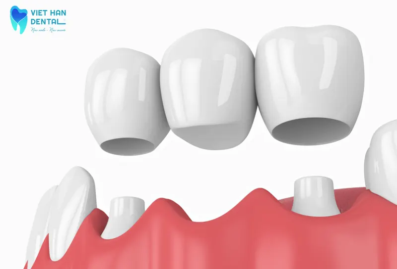 su-khac-nhau-giua-trong-rang-implant-va-cau-rang-su