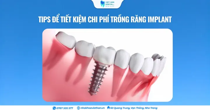 Tips để tiết kiệm chi phí trồng răng implant