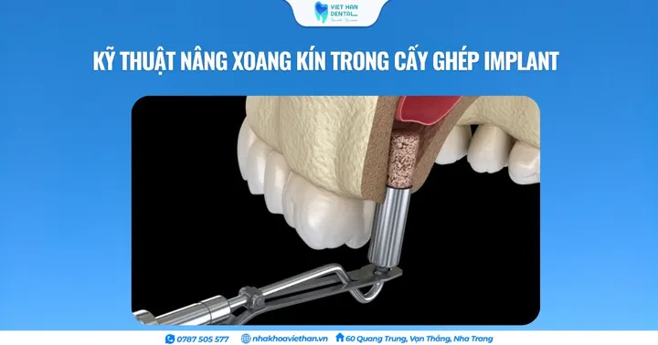 Kỹ thuật nâng xoang kín trong cấy ghép Implant