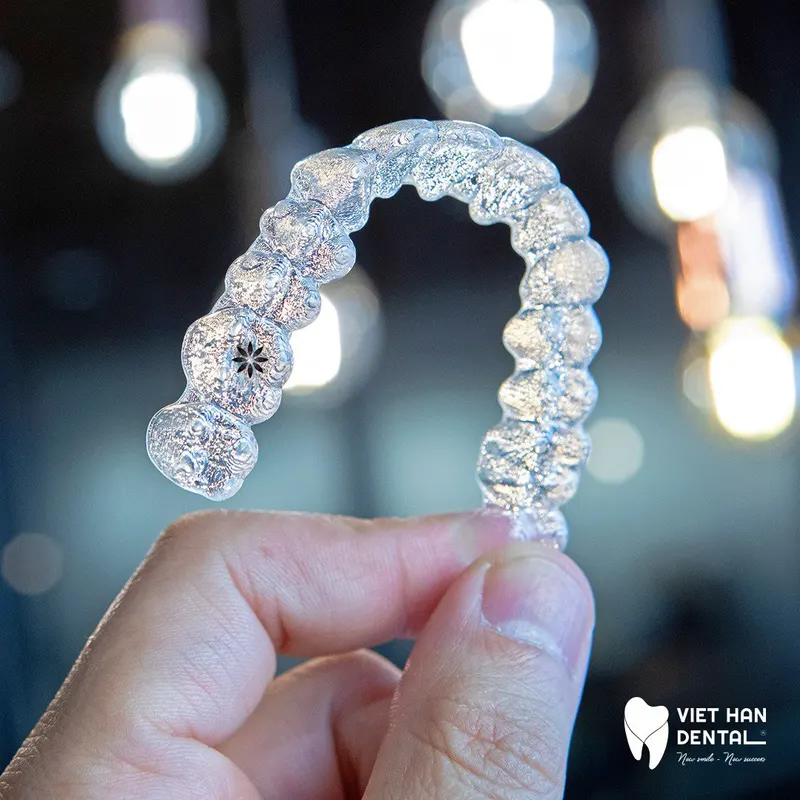 Nieng Rang Invisalign và vật liệu SmartTrack 