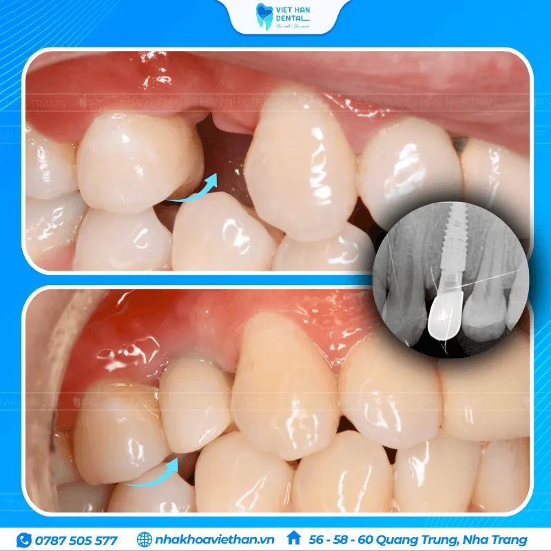 Trồng răng Implant đơn lẻ khôi phục răng đã mất