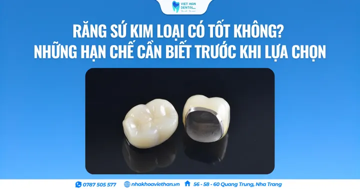 Răng sứ kim loại có tốt không? Những hạn chế cần biết trước khi lựa chọn
