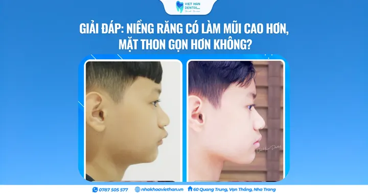 Giải đáp: Niềng răng có làm mũi cao hơn, mặt thon gọn hơn không?