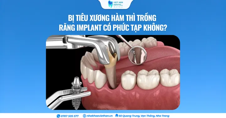 Bị tiêu xương hàm thì trồng răng Implant có phức tạp không?