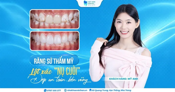 Dán sứ Veneer: Mỹ Anh khởi sắc thần thái nhờ nụ cười mới