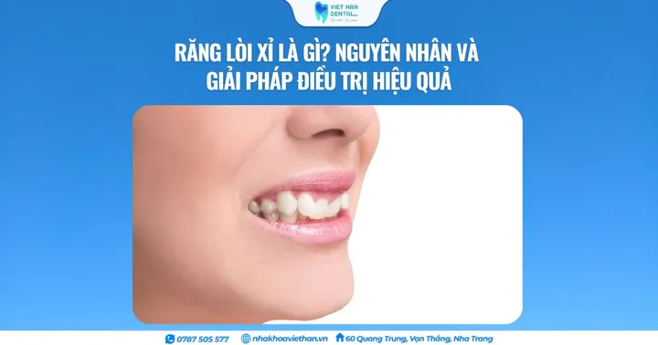 Răng lòi xỉ là gì? Nguyên nhân và giải pháp điều trị hiệu quả