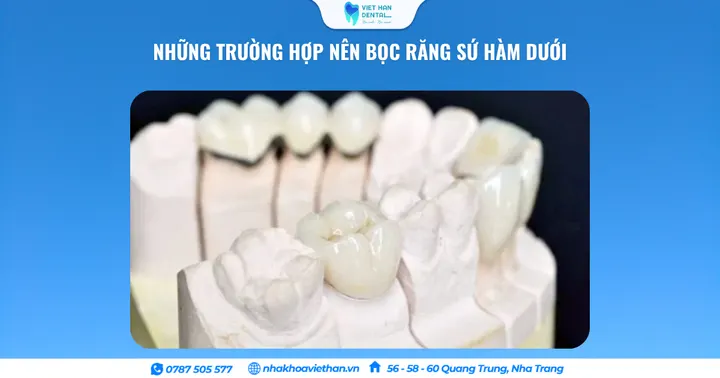 Các Trường Hợp Nên Bọc Răng Sứ Hàm Dưới Và Những Lưu Ý Quan Trọng