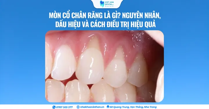Mòn cổ chân răng là gì? Nguyên nhân, dấu hiệu và cách điều trị hiệu quả