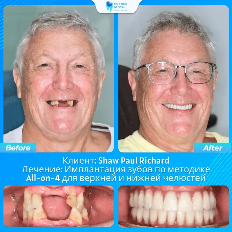 Shaw Paul Richard trước và sau trồng răng Implant All-on-4