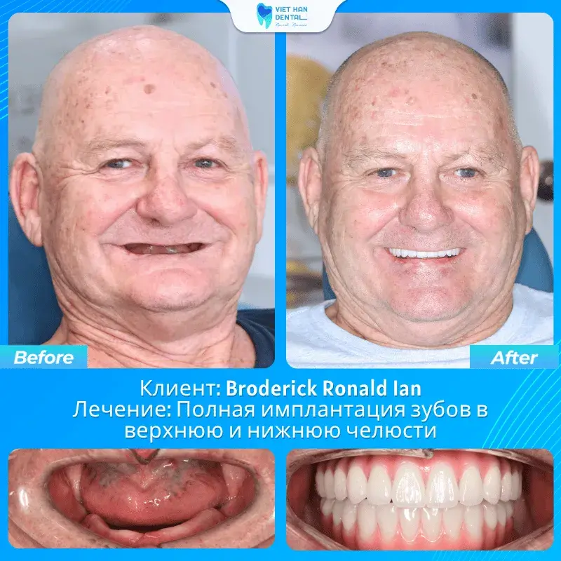Broderick Ronald Ian trước và sau trồng răng Implant toàn hàm