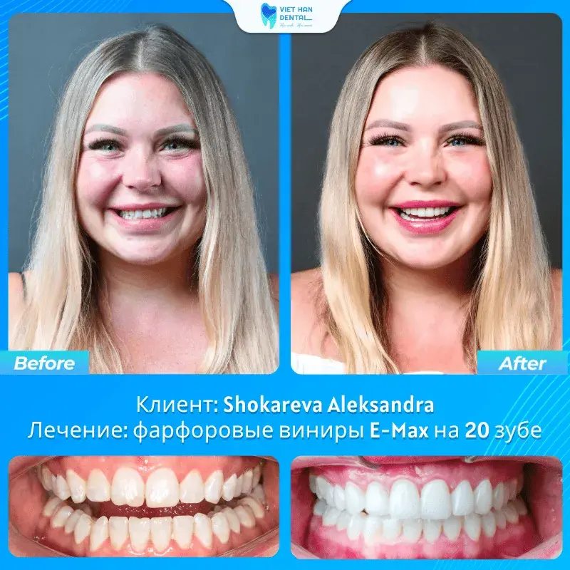 Результат лечения — Shokareva Aleksandra
