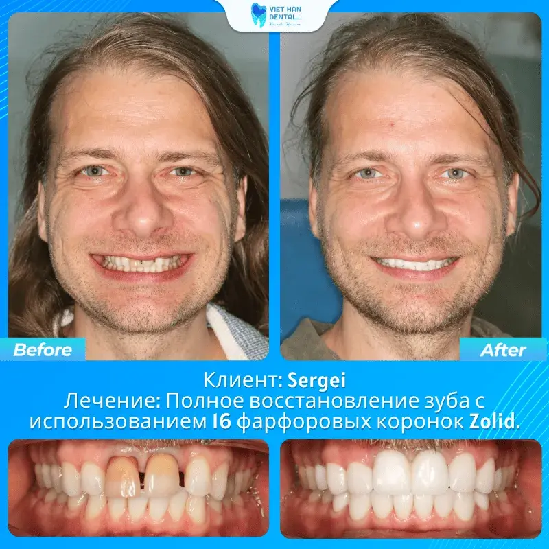 Результат лечения — Sergei