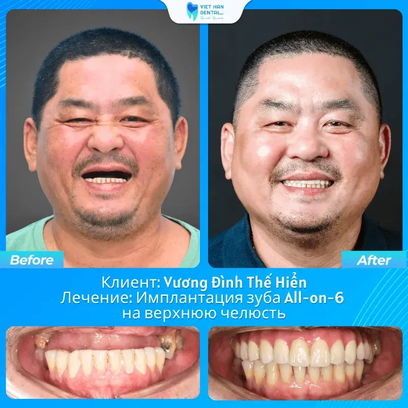 Vương Đình Thế Hiển trước và sau trồng răng Implant All-on-6